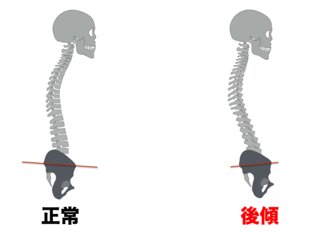 お尻の筋肉が固くなると骨盤が後ろに引っ張られて倒れてしまいます（骨盤後傾）。骨盤が後ろに倒れたままだと重心が後ろに移動してしまうため、人間は自然と重心を身体の真ん中に戻そうと代償運動を行います