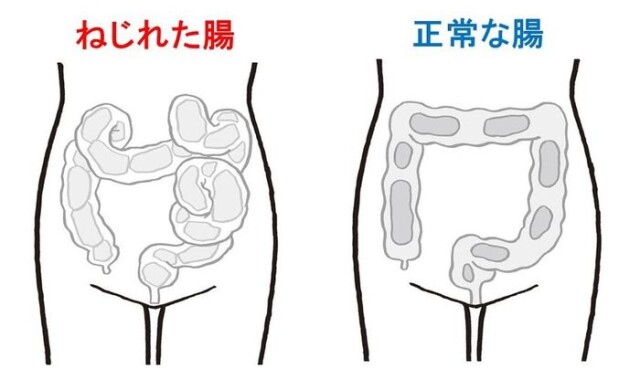 え なにそれ 便秘の原因は ねじれ腸 や 落下腸 かも まずはセルフチェックを コラム 緑のgoo