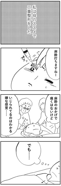 母のススメで二重整形をした