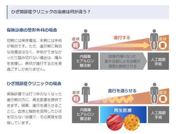 再生医療により、「膝関節症」の進行を遅らせることが可能に