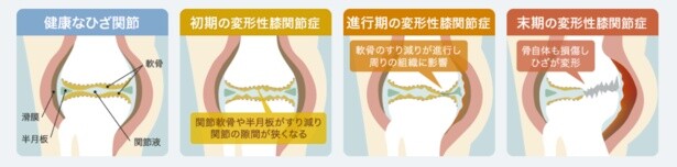 【画像】骨と骨の間の軟骨や半月板がすり減って発症する「変形性膝関節症」