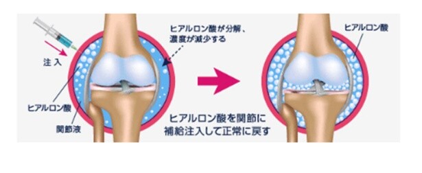 一定の効果が認められているヒアルロン酸注射