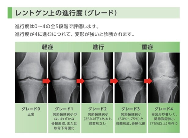 レントゲンを見ると一目瞭然。骨と骨の隙間には差があり、進行すると徐々に狭くなる