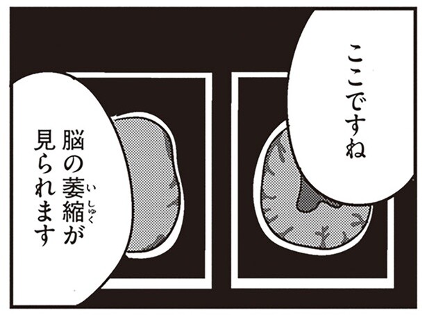「脳の萎縮が見られます」若年性認知症と診断された夫の隣で妻は呆然／夫がわたしを忘れる日まで（7）