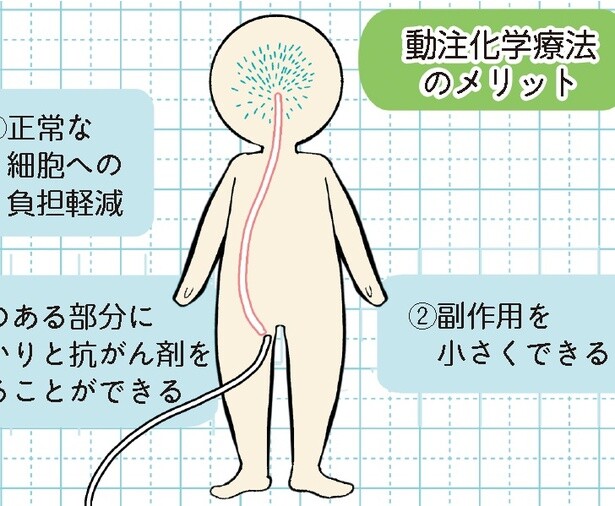 いよいよ入院！「動脈から抗がん剤を流します」お医者さんの説明を聞いてみると…【漫画の作者に聞く】